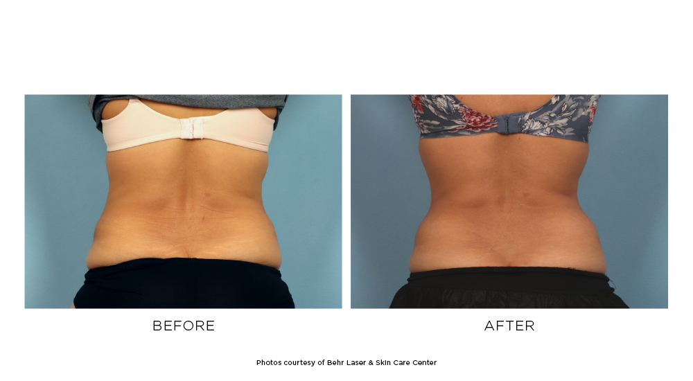 Two CoolSculpting® sessions on the flanks helped this patient achieve his  goals of reducing stubborn fat on his love handles. Individual…