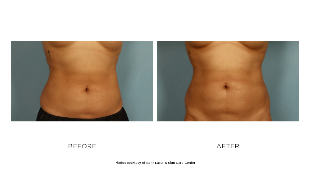Before and after CoolSculpting Elite results