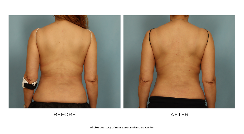 CoolSculpting® Elite Before & After Photos Patient 105, Boston, MA