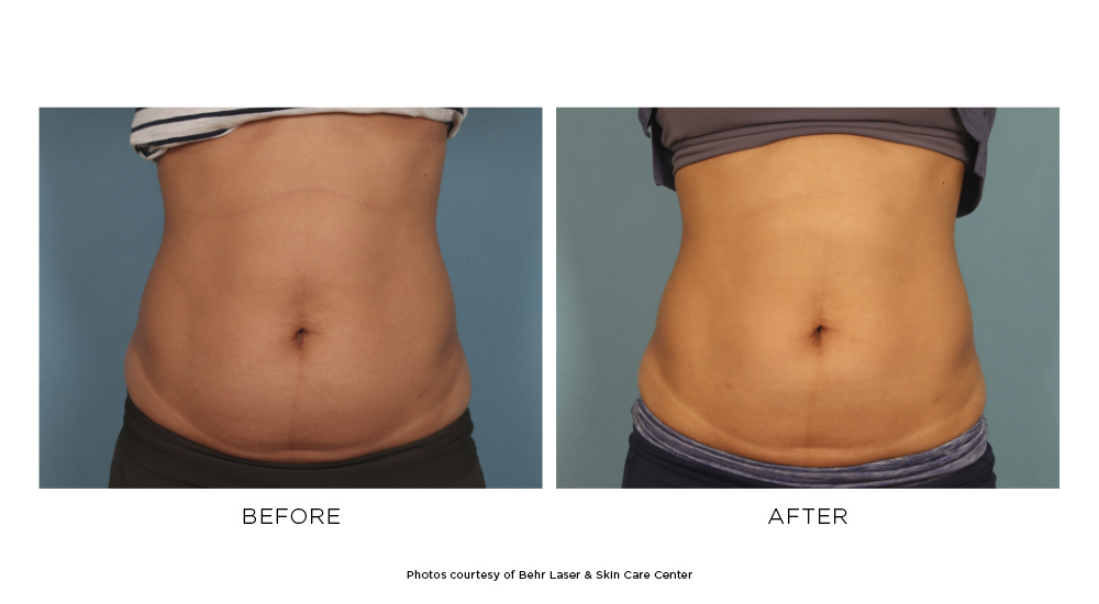 CoolSculpting®, Fresno, CA