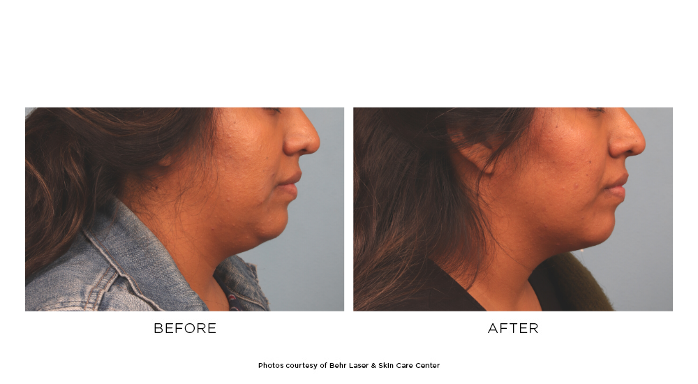 Before and after Coolsculpting Elite submental results