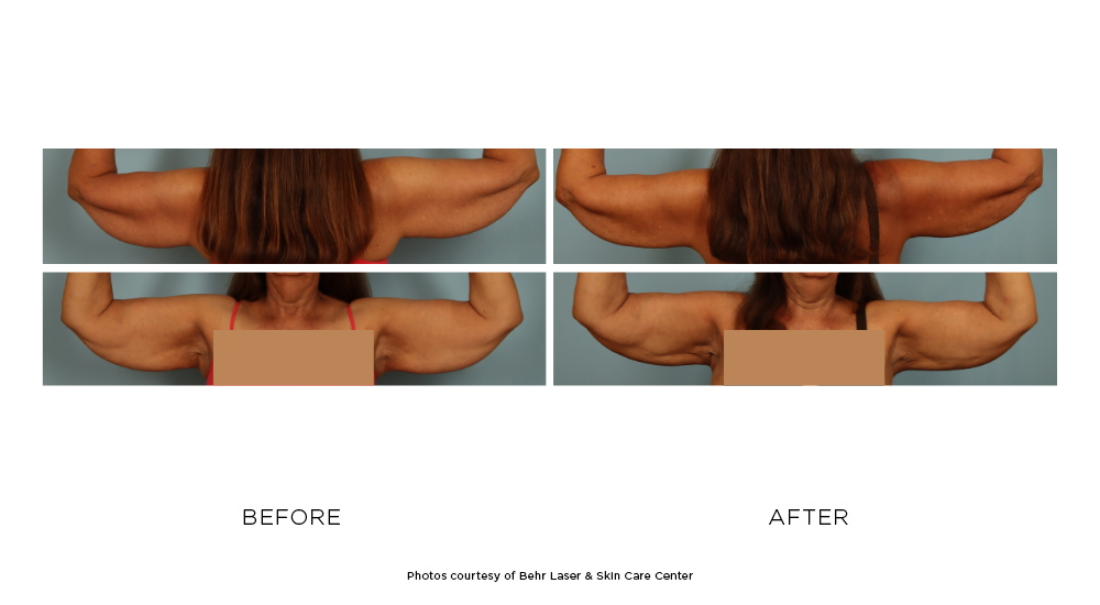 Before and after CoolSculpting Elite arm results