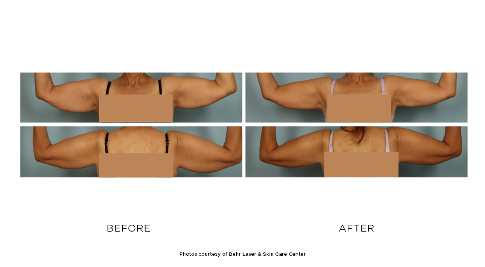Before and after CoolSculpting Elite arm results