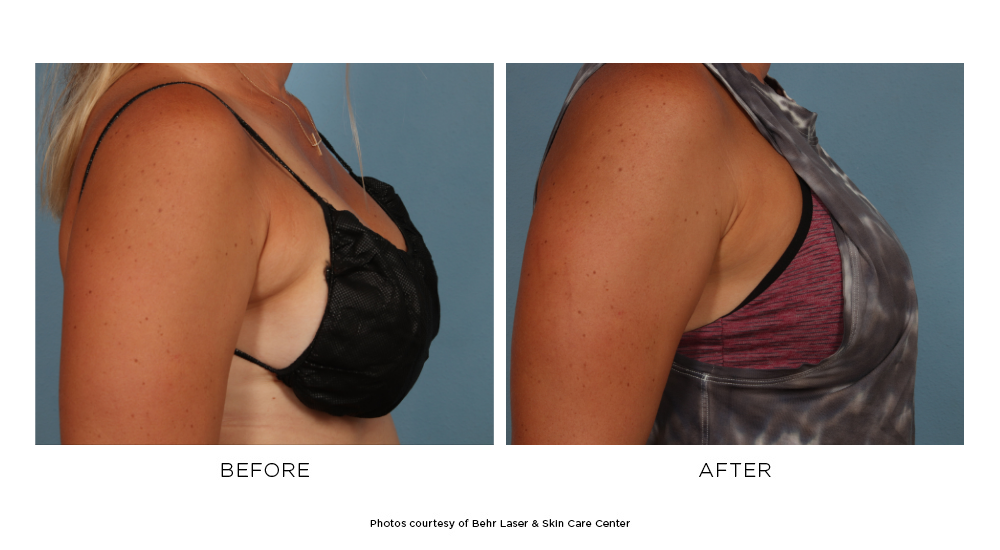Before and after CoolSculpting Elite breast results
