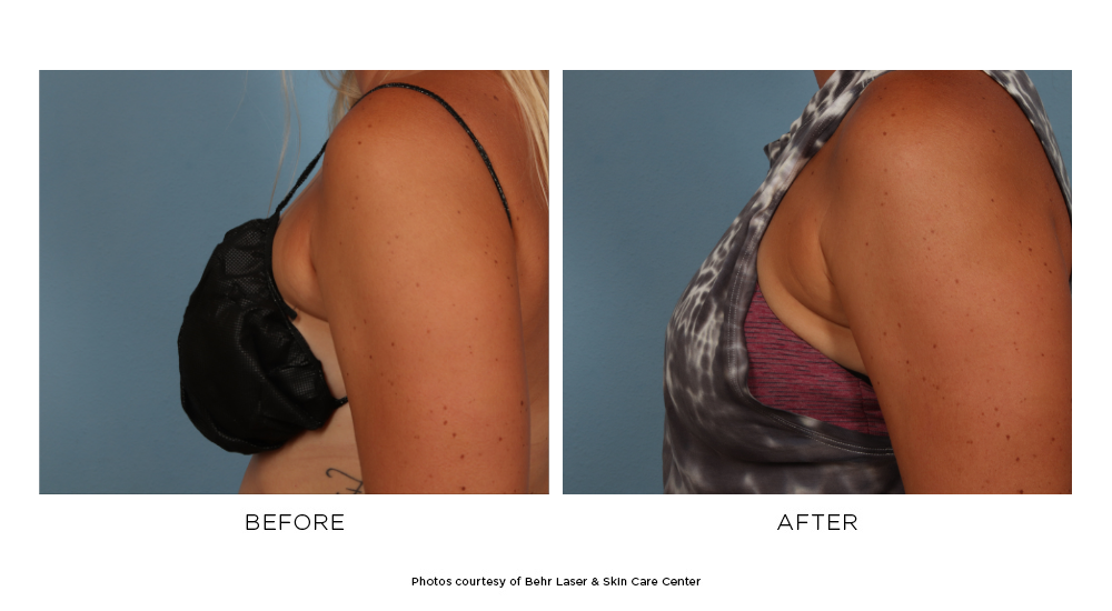Before and after CoolSculpting Elite breast results