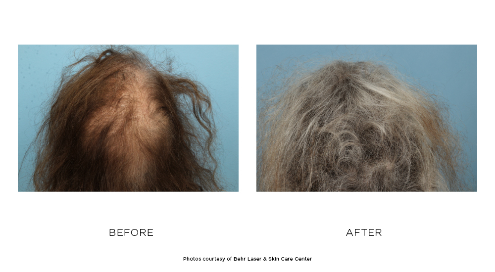 Before and after hair restoration results