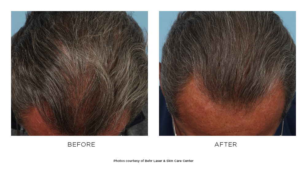 Before and after hair restoration results