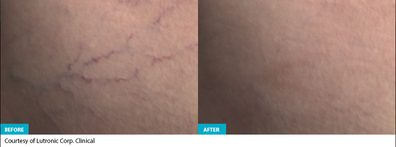 Derma V Before & After #1