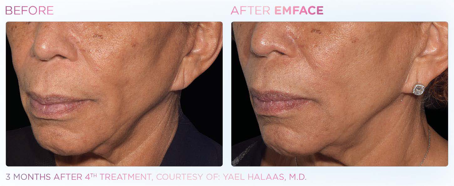 Before and after EMFACE results