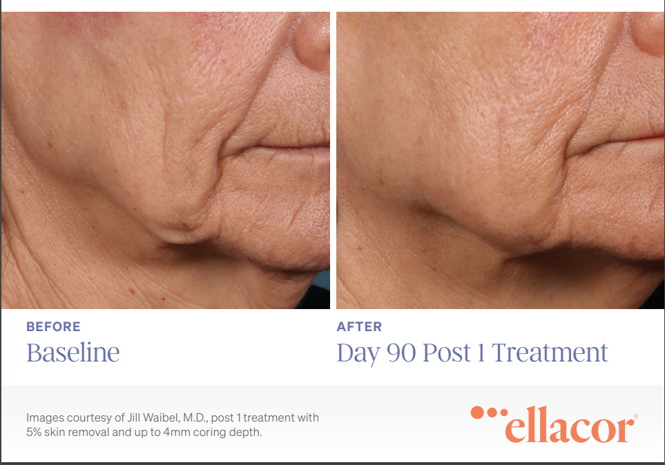 Before and after ellacor results