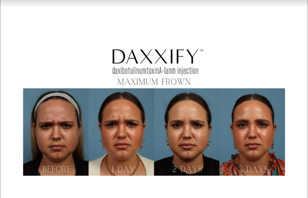 Before and after Daxxify results