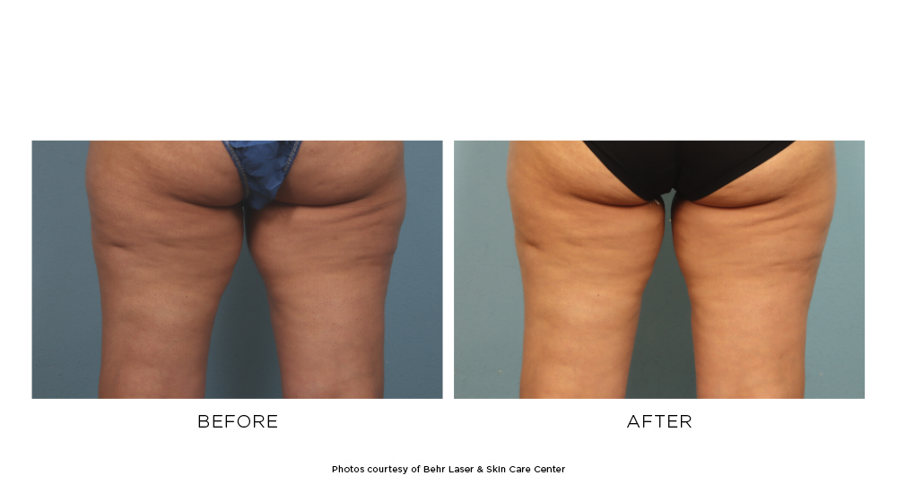 Before and after CoolSculpting Elite buttocks photos