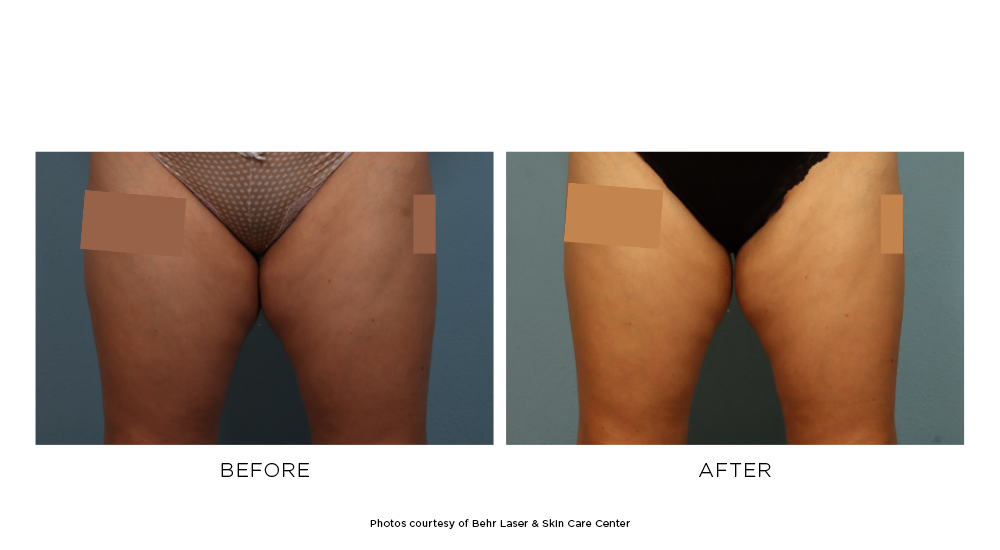 Before and after CoolSculpting Elite thigh results