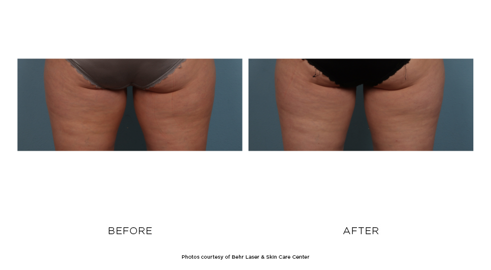 Before and after CoolSculpting Elite buttocks photos