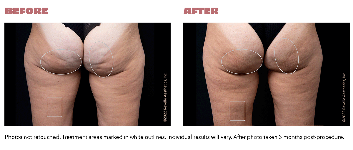 Before and after Avéli results